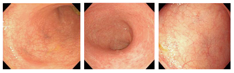 寛解期の潰瘍性大腸炎の内視鏡写真
