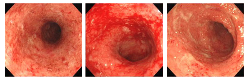 活動期の潰瘍性大腸炎の内視鏡写真