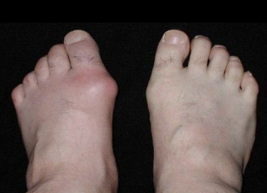 高尿酸血症（痛風）