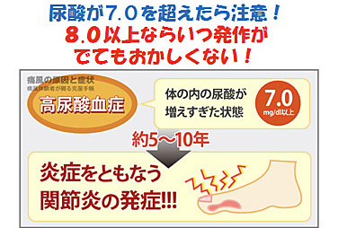 高尿酸血症（痛風）