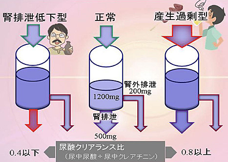 高尿酸血症の病型分類