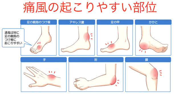 高尿酸血症の病型分類