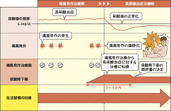痛風発作中の血清尿酸値は低い
