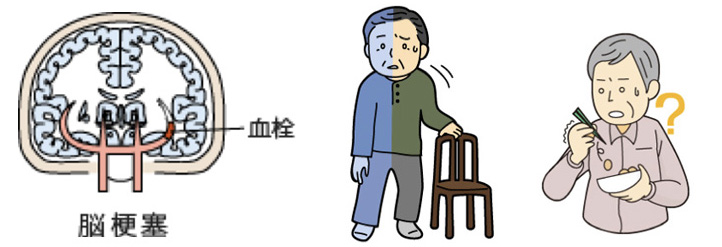 脳梗塞