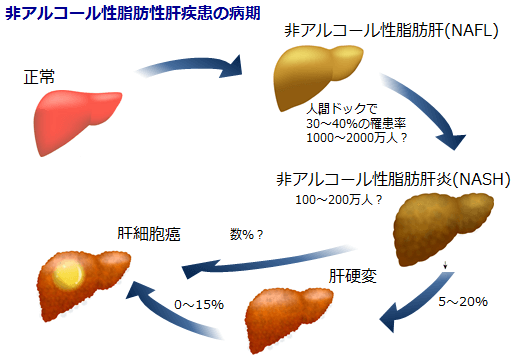 ③ 非アルコール性 脂肪肝NAFLD(Non Alcoholic Fatty Liver Disease)、脂肪性肝炎(NASH)